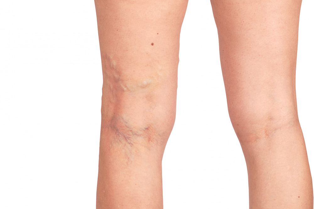 Spider Veins